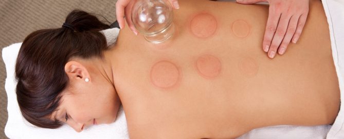 Chinese Cupping Weight Loss